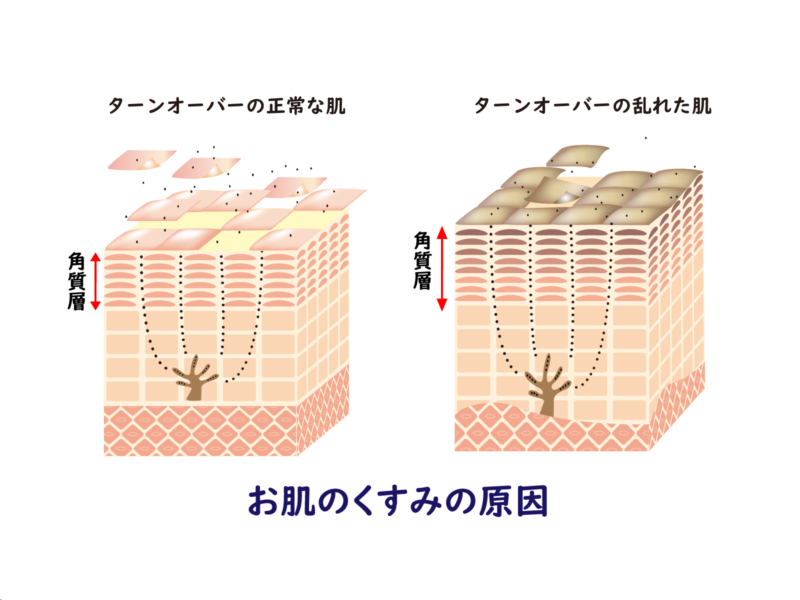 HIFU＋美肌治療による効果～くすみ・しわ・たるみについて～